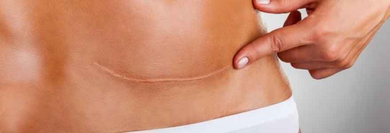 Cómo ocultar la cicatriz de abdominoplastia